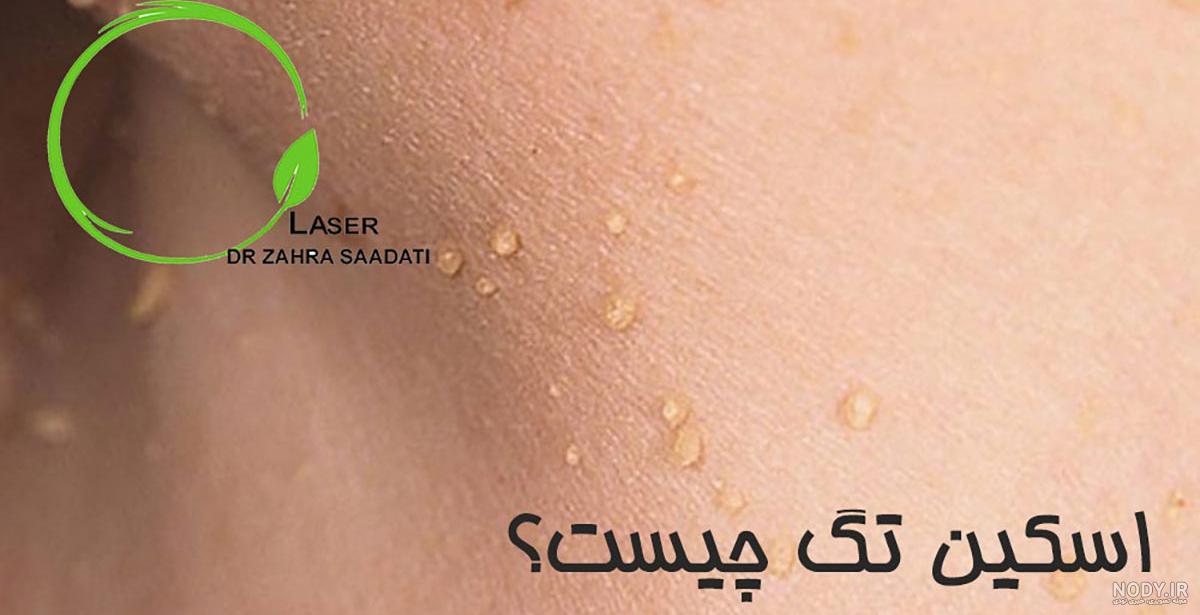جوش داخل مقعدی نشانه چیست؟{عکس واقعی } و درمان خانگی و سنتی | درمان تهران