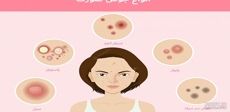 شناخت جوش صورت همراه با تصاویر| معرفی انواع جوش ها شناخت جوش صورت همراه با تصاویر| معرفی انواع جوش ها