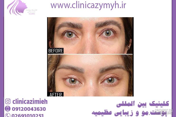 عمل چشم گربه ای توسط فوق تخصص پلاستیک با تغییر عالی-کلینیک vip تهران