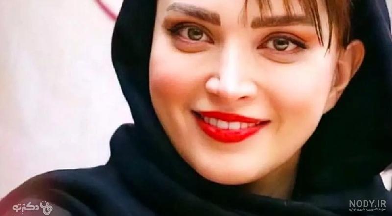 عمل چشم گربه ای صفر تا صد؛ قیمت، عوارض و تصاویر قبل و بعد