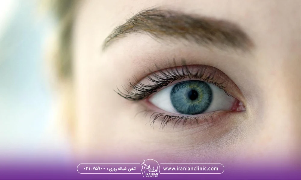 عمل چشم گربه ای یا کانتوپلاستی چیست؟ نحوه انجام این جراحی زیبایی و عوارض آن