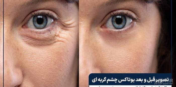 عمل چشم گربه ای؛ بررسی روش‌های مختلف از بوتاکس تا فیلر