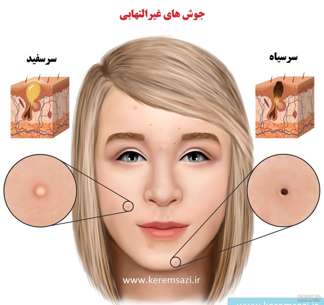 عکس انواع جای جوش عکس انواع جای جوش