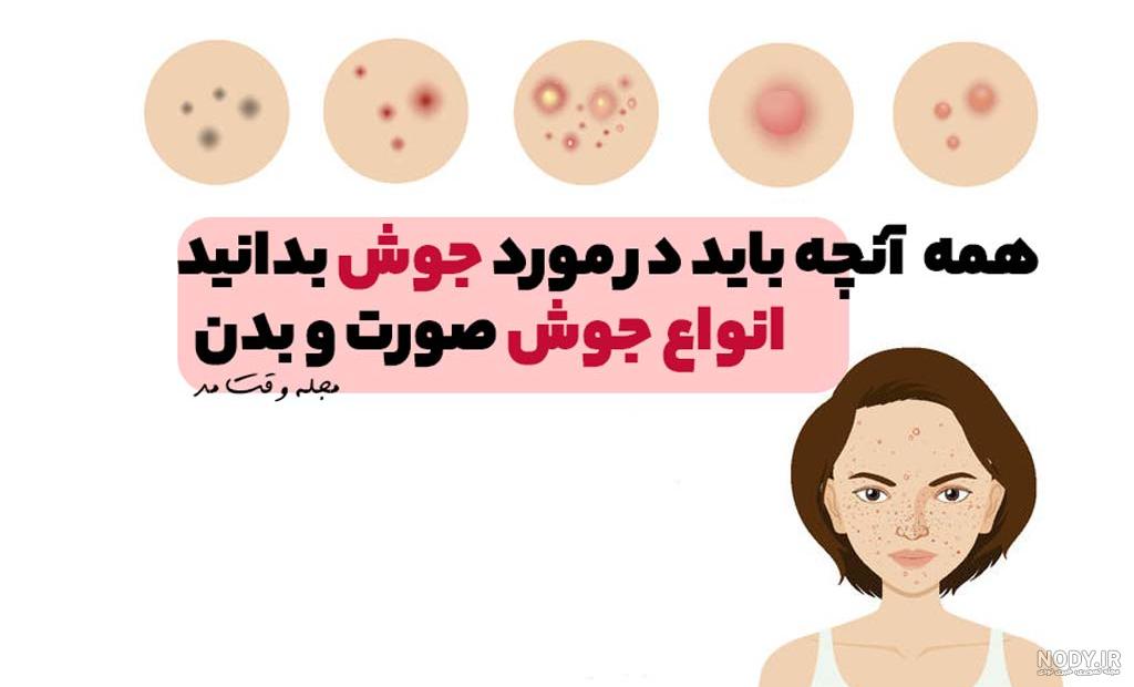 عکس انواع جوش بدن عکس انواع جوش بدن