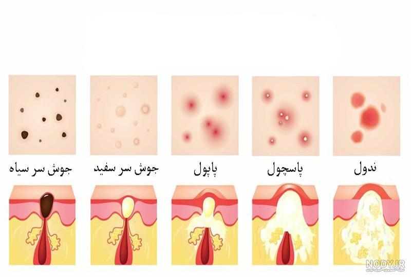 عکس انواع جوش ها عکس انواع جوش ها