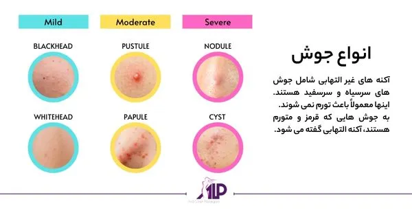 عکس انواع جوش در کودکان عکس انواع جوش در کودکان