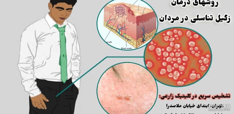 عکس جوش ناحیه تناسلی مردان