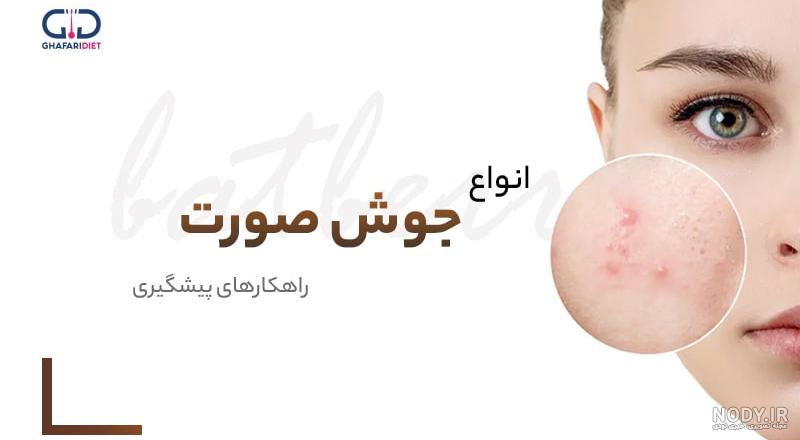 عکس جوش های کبد چرب (تفاوت آنها با جوش هورمونی) | ازنیک درمان عکس جوش های کبد چرب (تفاوت آنها با جوش هورمونی) | ازنیک درمان