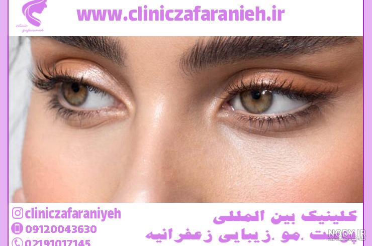 عکس های عمل چشم گربه ای