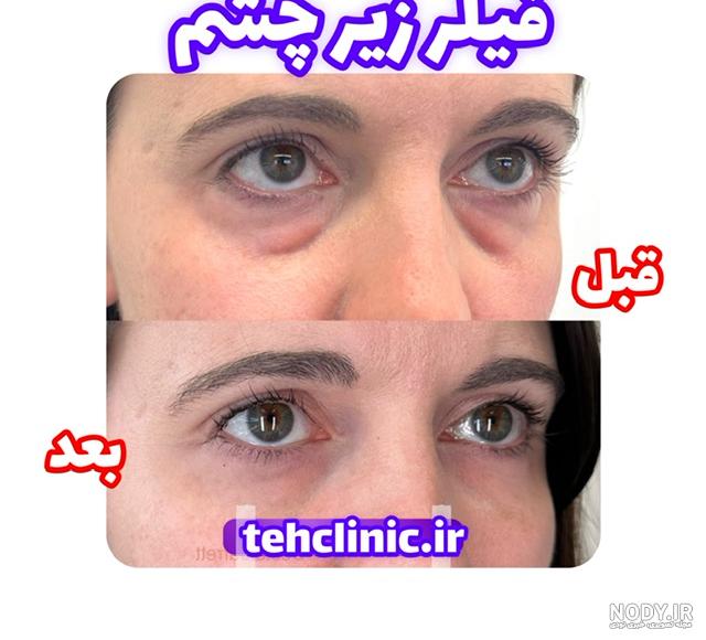 عکس فیلر چشم