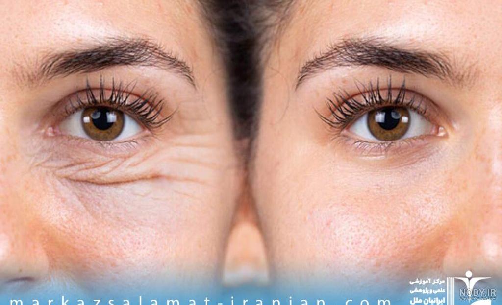 عکس مزو ژل زیر چشم عکس مزو ژل زیر چشم