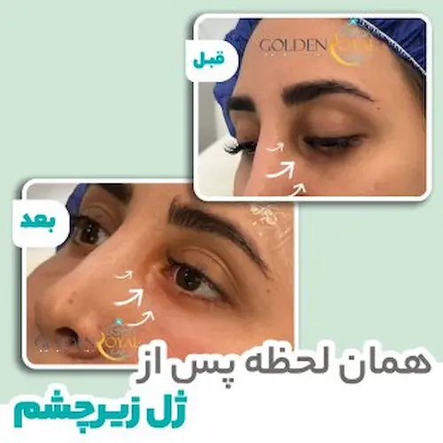 قیمت مزوژل زیر چشم جالپرو | مزوشاپ 💜 قیمت مزوژل زیر چشم جالپرو | مزوشاپ 💜