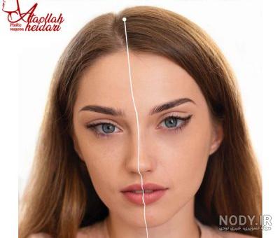 لیفت چشم گربه ای بدون جراحی 😊 - دکتر غزال یزدانی
