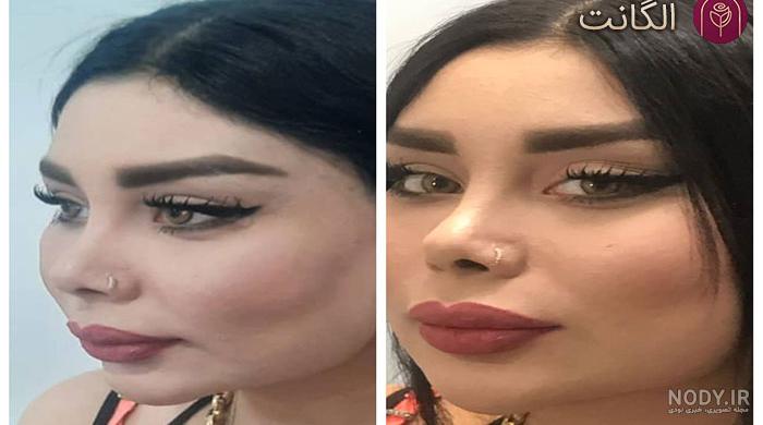 لیفت چشم گربه ای بدون جراحی 😊 - دکتر غزال یزدانی