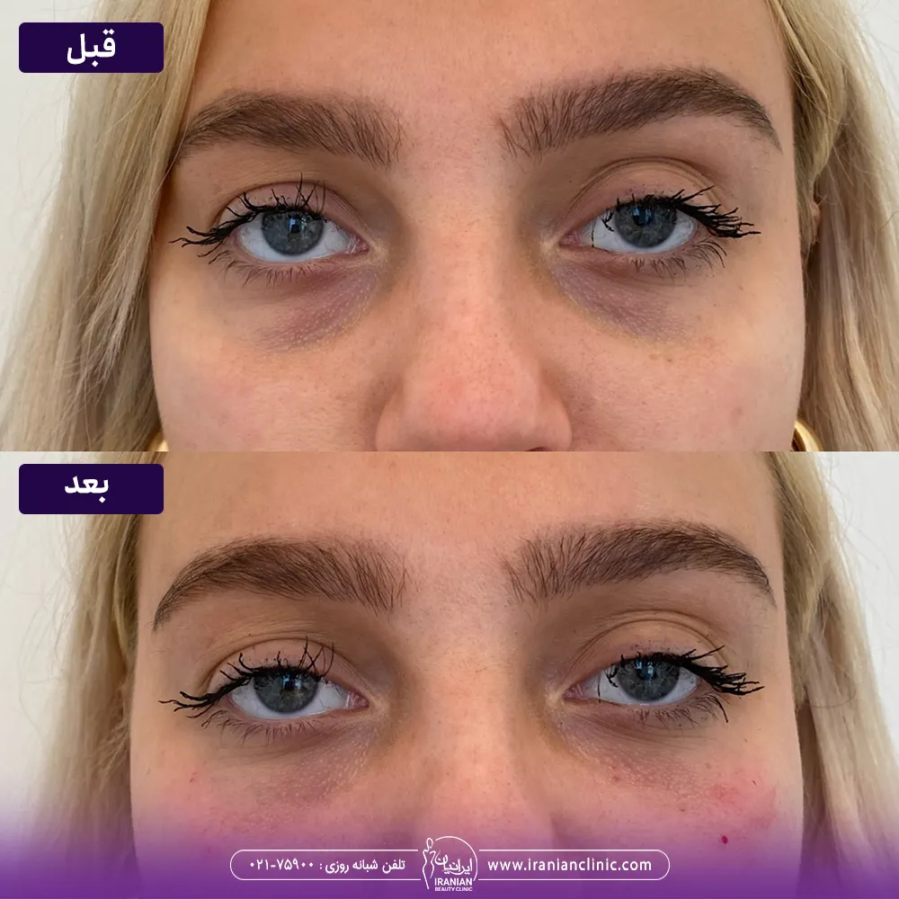 مراکز تزریق مزوژل در تهران ✔️+ فیلم,عکس,قیمت,عوارض - کِلینیک42 مراکز تزریق مزوژل در تهران ✔️+ فیلم,عکس,قیمت,عوارض - کِلینیک42