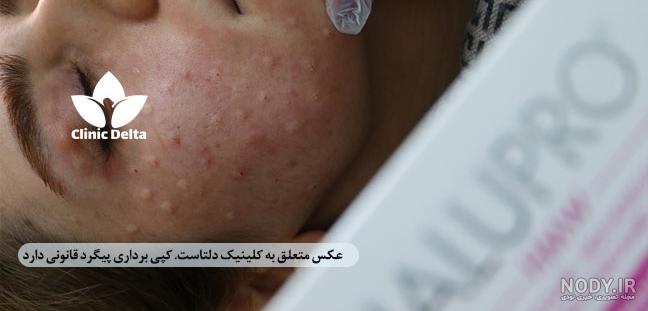 مزوژل زیر چشم جالپرو یانگ آی | جوانساز و آبرسان چشم مزوژل زیر چشم جالپرو یانگ آی | جوانساز و آبرسان چشم