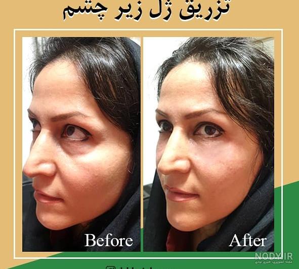 مزوژل زیر چشم چیست؟ | بررسی انواع مزوژل زیر چشم | اوزونیک درمان لاین زیبایی براکا مزوژل زیر چشم چیست؟ | بررسی انواع مزوژل زیر چشم | اوزونیک درمان لاین زیبایی براکا