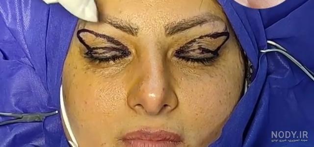 هر آن چیزی که باید در مورد بلفاروپلاستی چشم گربه ای بدانید - آی گل