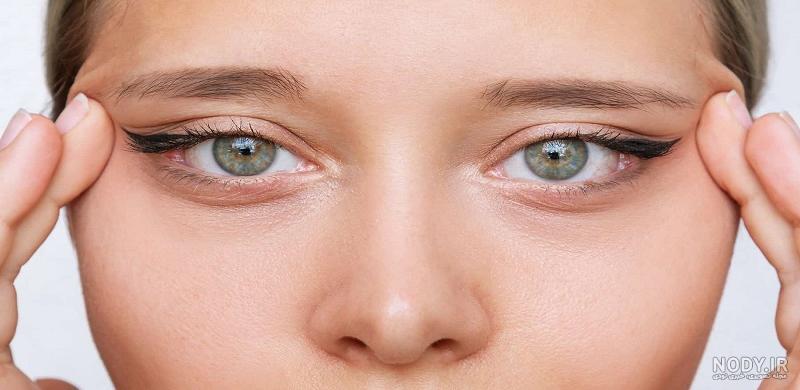 چشم گربه ای طبیعی چیست؟ - کلینیک بین المللی پوست و مو زیبایی زعفرانیه