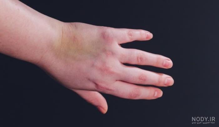 6 راهکار معجزه آسا خانگی برای درمان کبودی زیر چشم (چشم کَبود)