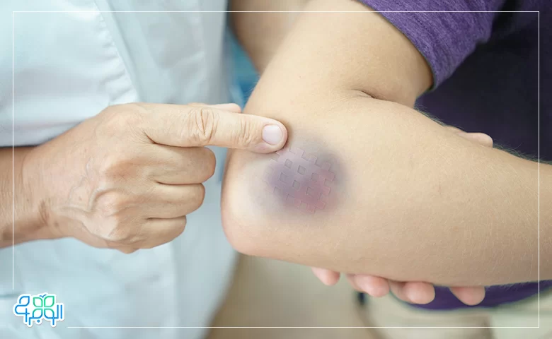 علت و پیشگیری کبودی دست بعد از خونگیری | مرکز فلبوتومی ریکاوری
