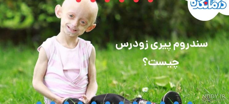 سندرم پیری زودرس؛ علت، علائم، تشخیص و درمان - درمانکده سندرم پیری زودرس؛ علت، علائم، تشخیص و درمان - درمانکده