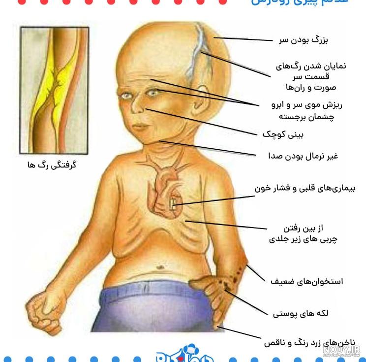 پیری زودرس در بیماران دیابتی-آنلاین سلامت پیری زودرس در بیماران دیابتی-آنلاین سلامت