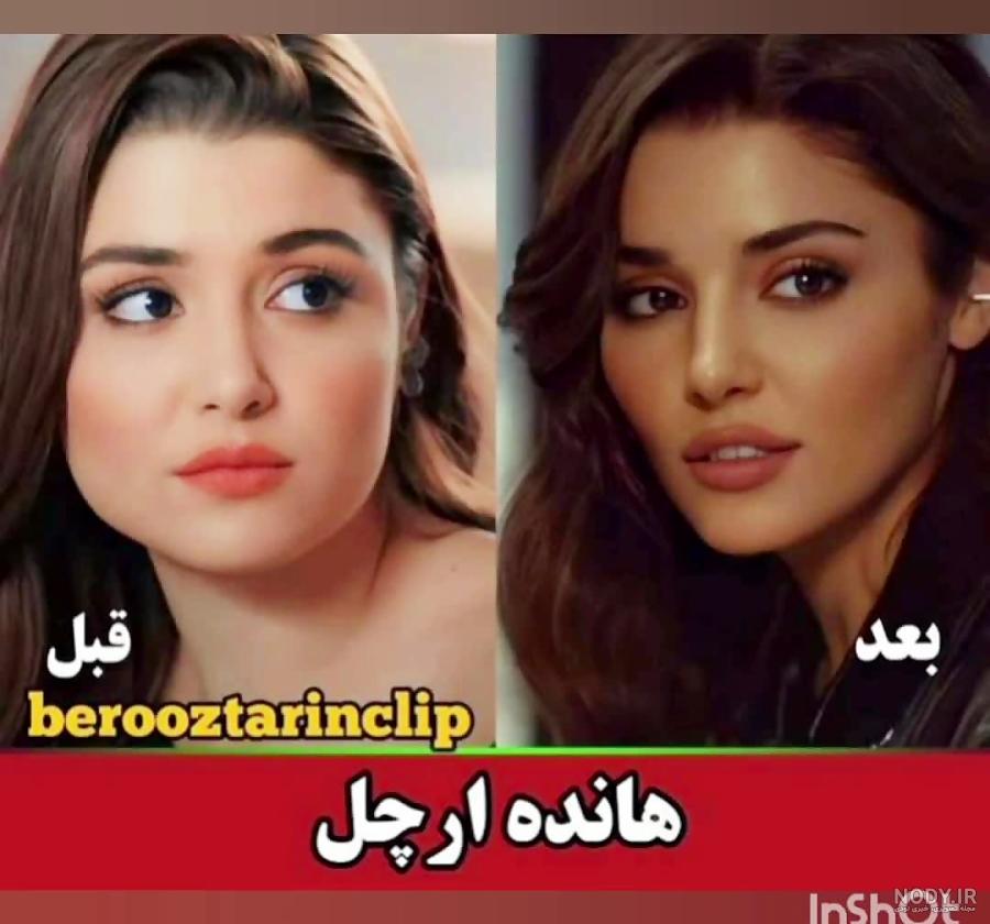 عکس قبل و بعد از عمل زیبایی هانده ارچل عکس قبل و بعد از عمل زیبایی هانده ارچل
