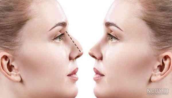 عکس هانده ارچل قبل از عمل جراحی - عکس نودی