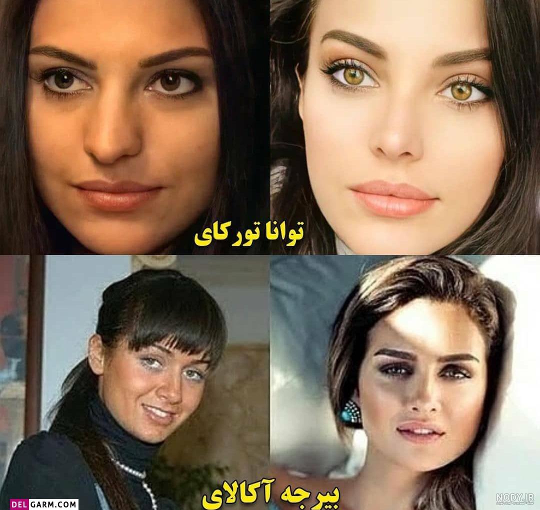 عکس هانده ارچل قبل و بعد از عمل - عکس نودی عکس هانده ارچل قبل و بعد از عمل - عکس نودی