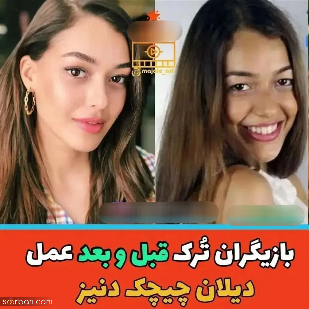 چهره بازیگران مطرح ترکیه ای قبل و بعد از عمل های متعدد (+عکس) | عصر ترکیه