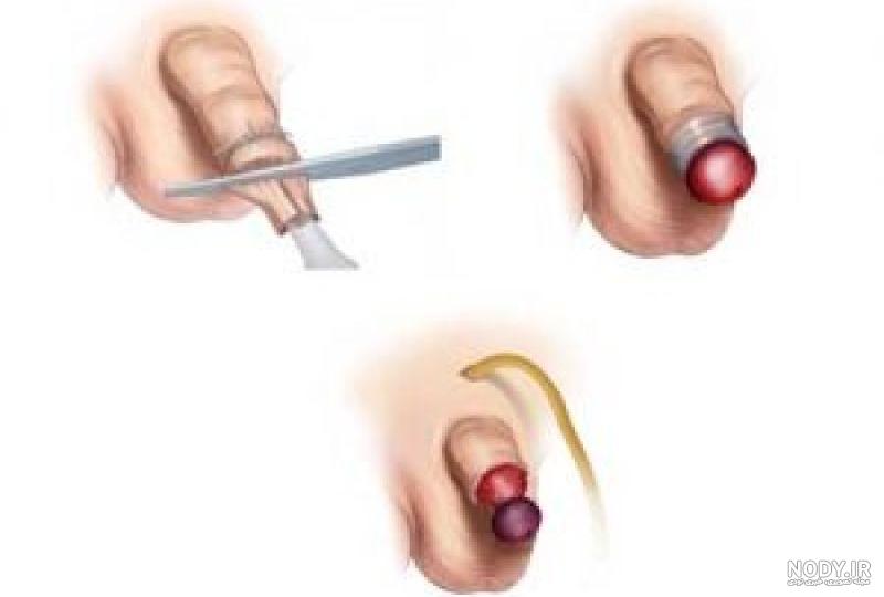 ناحیه ختنه گاه مرد کجاست + عکس ختنه گاه