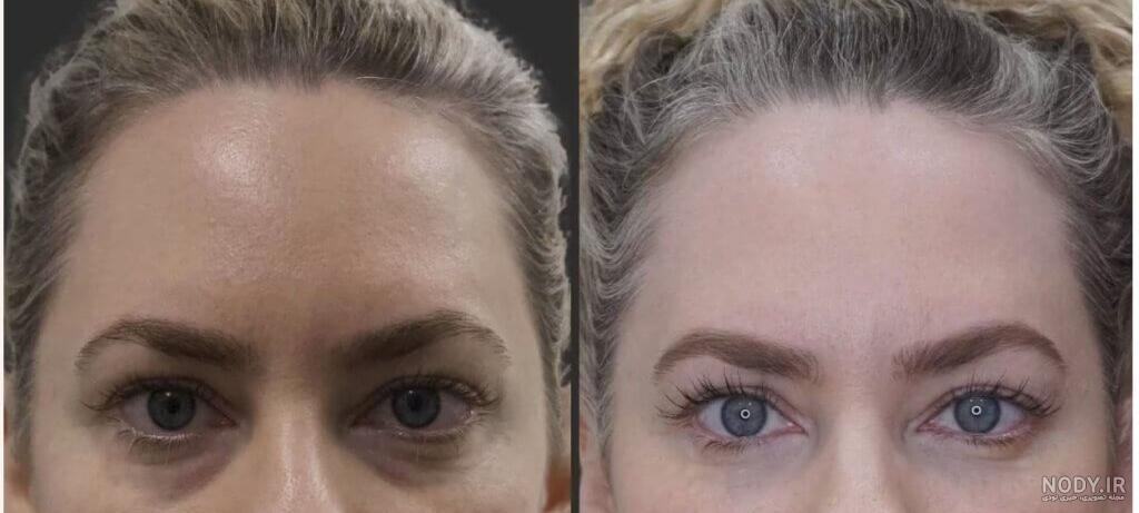 آموزش تزریق ژل فیلر لب و صورت | + فیلم آموزشی تزریق ژل لب