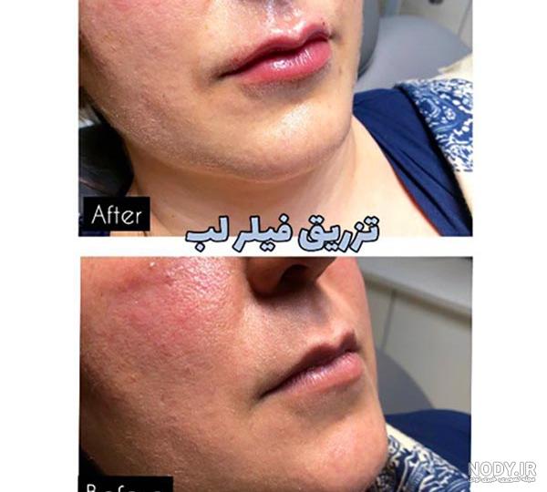 با عکس های قبل و بعد ژل لب می توانم فرم لبم را انتخاب کنم؟ - کلینیک دلتا
