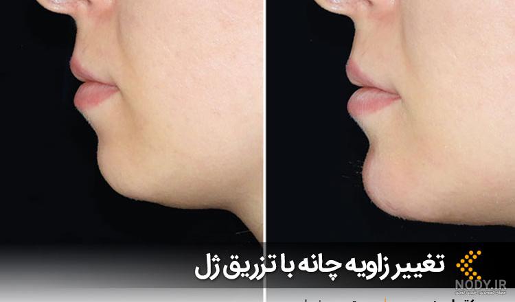 تزریق ژل و فیلر | تفاوت ژل و فیلر | تخلیه ژل و فیلر | ماندگاری ژل و فیلر تزریق ژل و فیلر | تفاوت ژل و فیلر | تخلیه ژل و فیلر | ماندگاری ژل و فیلر