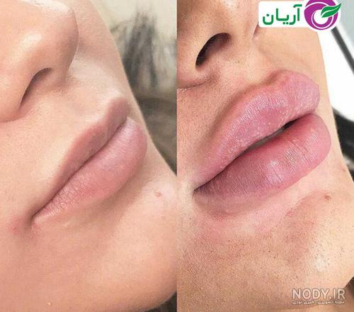 تزریق ژل لب مدل نچرال + فیلم و عکس تزریق ژل لب طبیعی