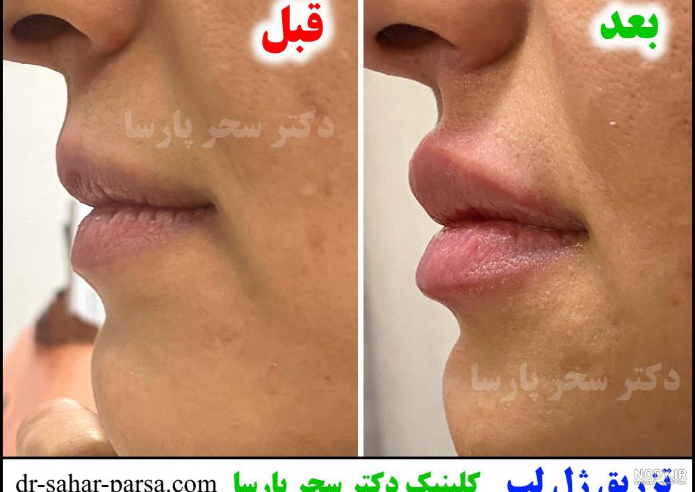 تزریق ژل - هزینه، نمونه کار، مراقبت ها و عوارض - رزرو نوبت در کلینیک ساعی