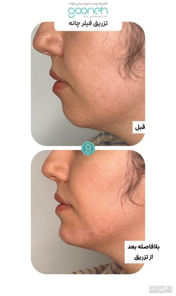 تزریق ژل در چانه و روش تزریق ژل چانه در کلینیک پوست و مو | کلینیک رز تزریق ژل در چانه و روش تزریق ژل چانه در کلینیک پوست و مو | کلینیک رز
