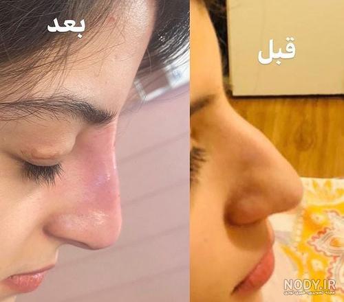 تزریق ژل چانه - عکس قبل و بعد، مدت زمان ماندگاری آن | کلینیک مارال سلامت ایرانیان تزریق ژل چانه - عکس قبل و بعد، مدت زمان ماندگاری آن | کلینیک مارال سلامت ایرانیان
