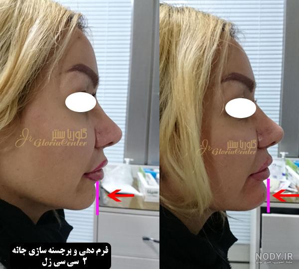 تزریق ژل چانه، ماندگاری، هزینه | کلینیک تزریق فیلر دکتر رامین مدرسی تزریق ژل چانه، ماندگاری، هزینه | کلینیک تزریق فیلر دکتر رامین مدرسی