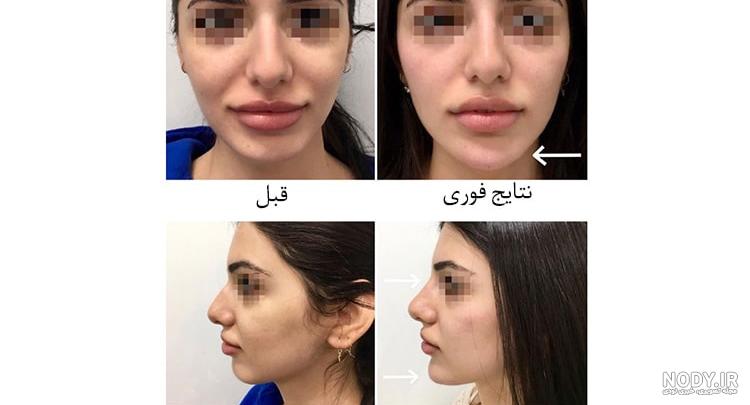 تصاویر تزریق ژل و فیلر + تصاویر قبل و بعد نمونه کار های دکتر یحیوی تصاویر تزریق ژل و فیلر + تصاویر قبل و بعد نمونه کار های دکتر یحیوی