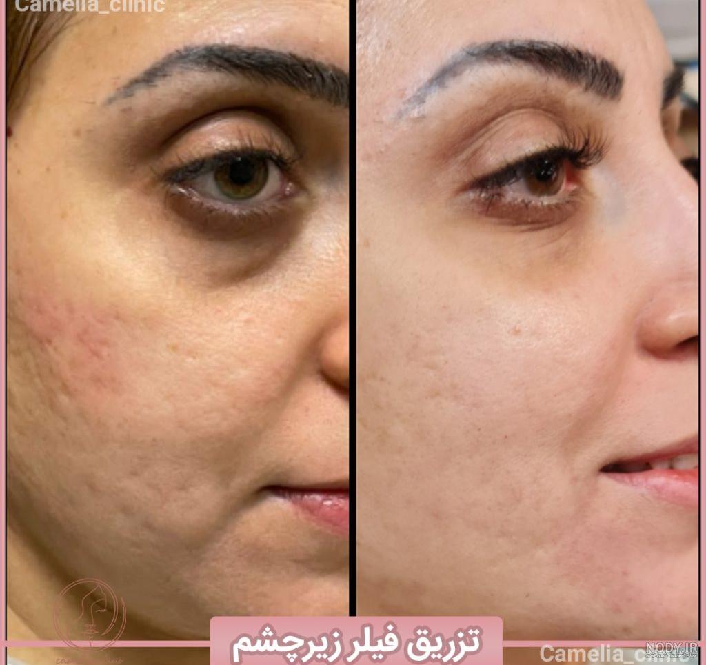 تصاویر خدمات لیزر و زیبایی بیماران کلینیک بصورت واقعی - کلینیک کاملیا تصاویر خدمات لیزر و زیبایی بیماران کلینیک بصورت واقعی - کلینیک کاملیا