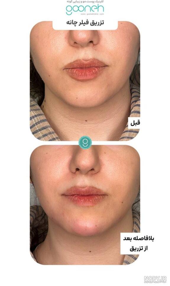تصاویر خدمات لیزر و زیبایی بیماران کلینیک بصورت واقعی - کلینیک کاملیا تصاویر خدمات لیزر و زیبایی بیماران کلینیک بصورت واقعی - کلینیک کاملیا
