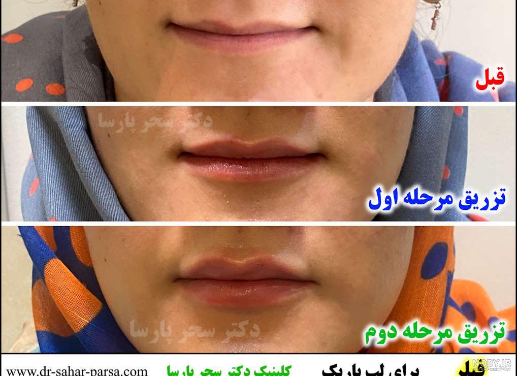 تصاویر قبل و بعد از تزریق ژل
