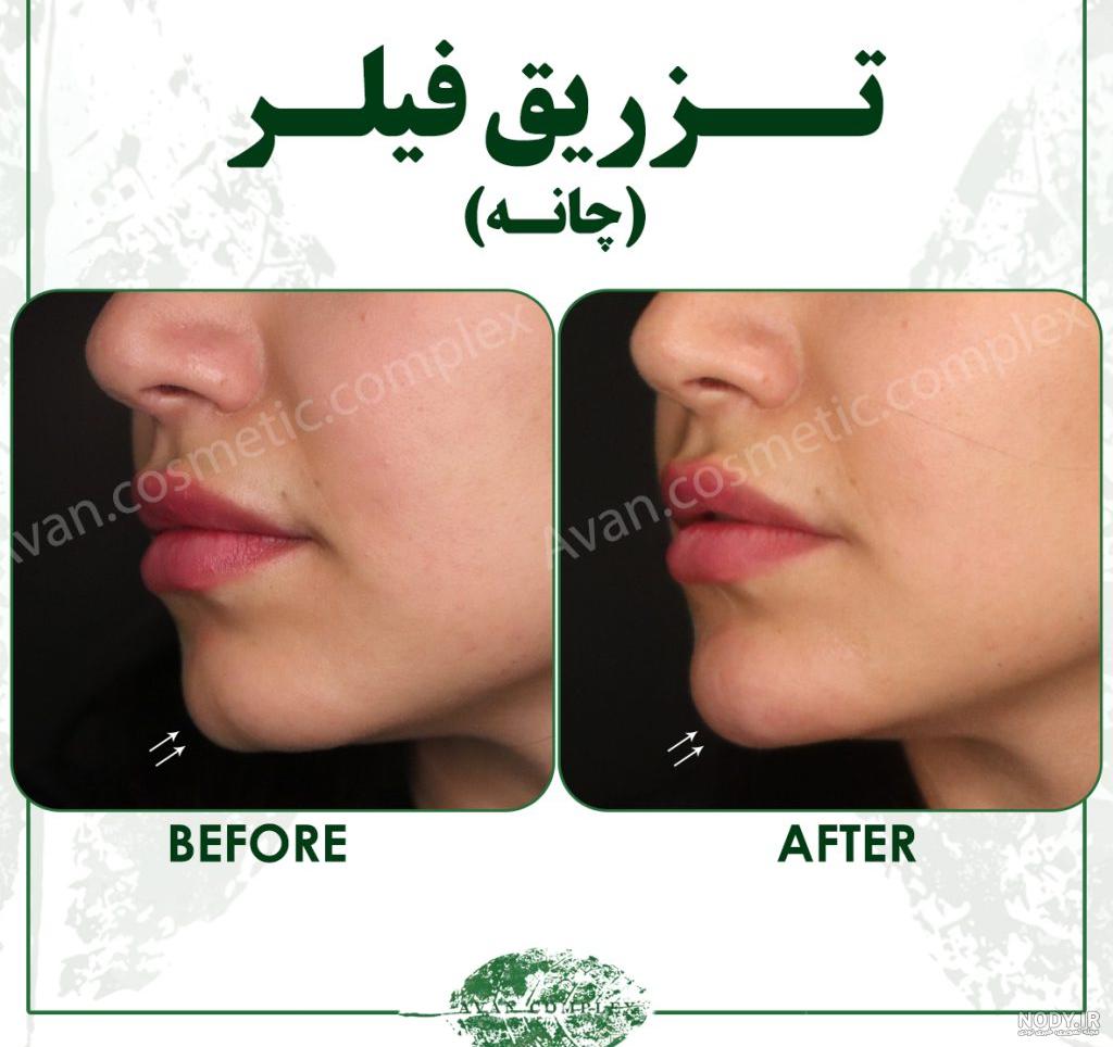 تصاویر قبل و بعد از تزریق ژل تصاویر قبل و بعد از تزریق ژل