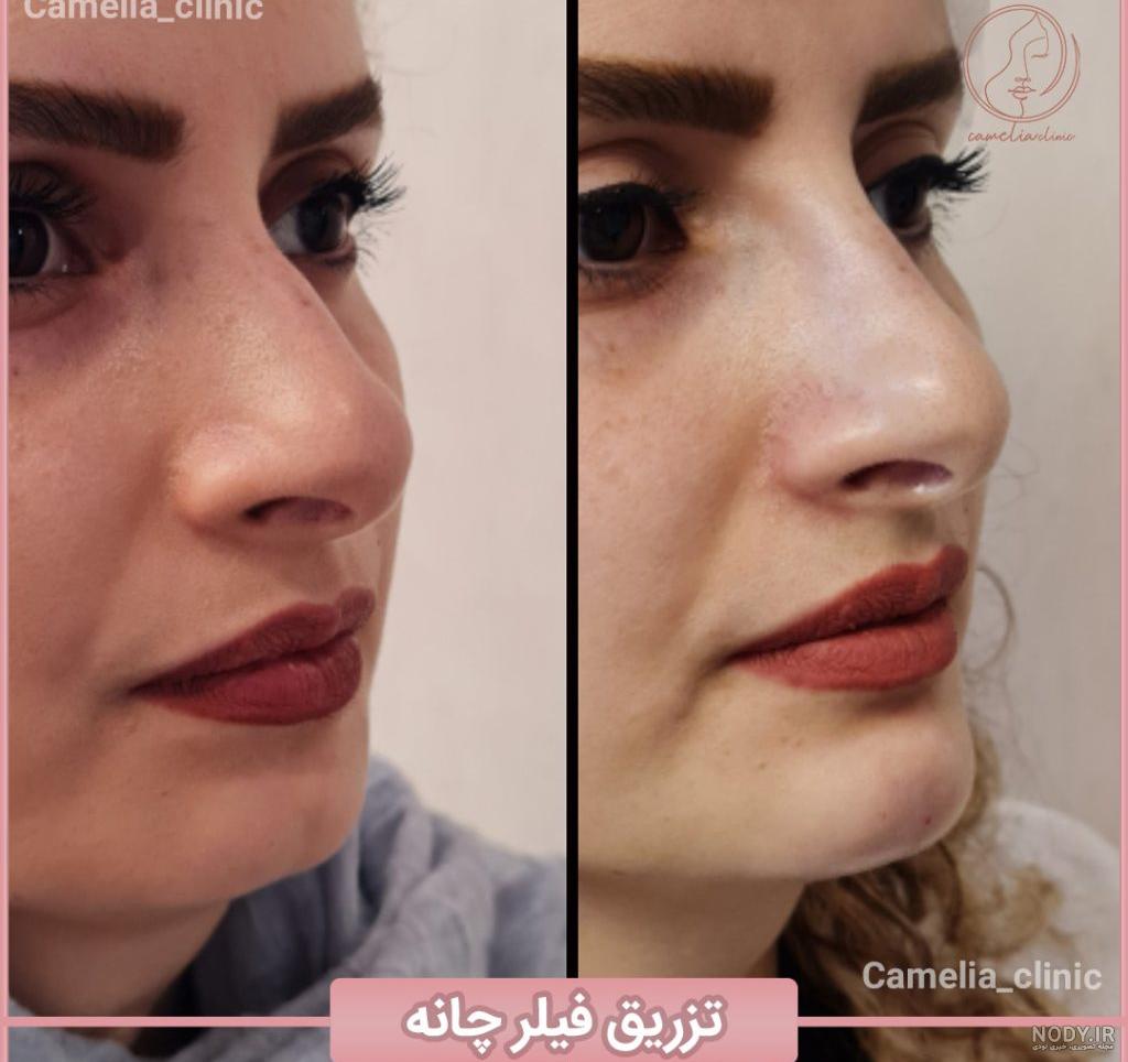 تصاویر قبل و بعد از تزریق ژل تصاویر قبل و بعد از تزریق ژل