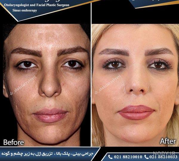 تصاویر قبل و بعد تزریق فیلر چانه با برند ایتالیایی امریکایی - تزریق چربی اصفهان تصاویر قبل و بعد تزریق فیلر چانه با برند ایتالیایی امریکایی - تزریق چربی اصفهان
