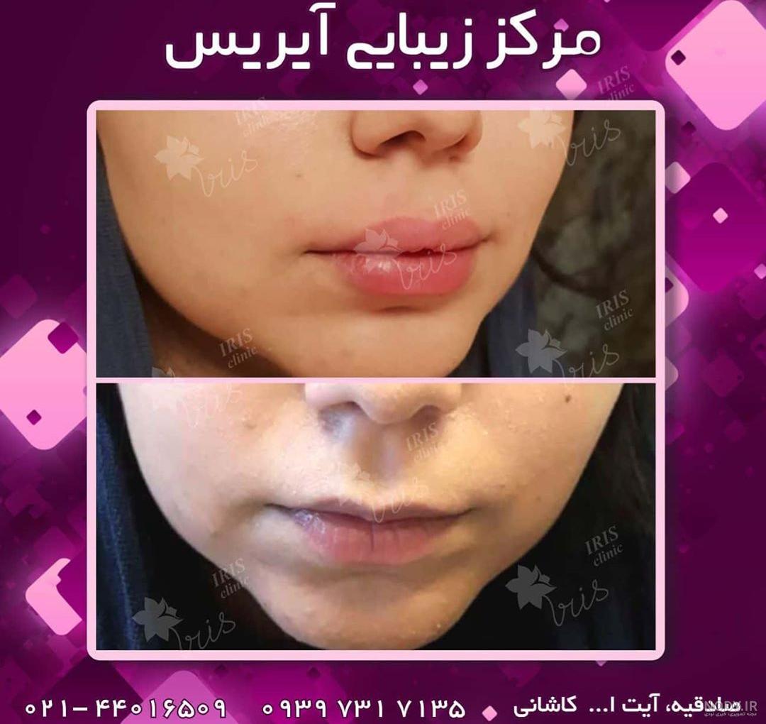 زاویه دهی و کانتورینگ صورت گرد با فیلر +فیلم و عکس قبل و بعد زاویه دهی و کانتورینگ صورت گرد با فیلر +فیلم و عکس قبل و بعد