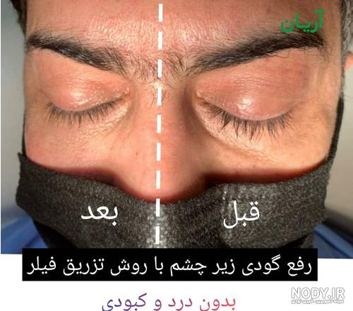 عکس تزریق ژل زیر چشم قبل و بعد