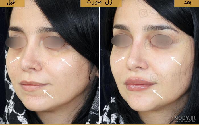 عکس تزریق ژل لب - 10 نکته مهم در تزریق ژل لب - گلوریا سنتر